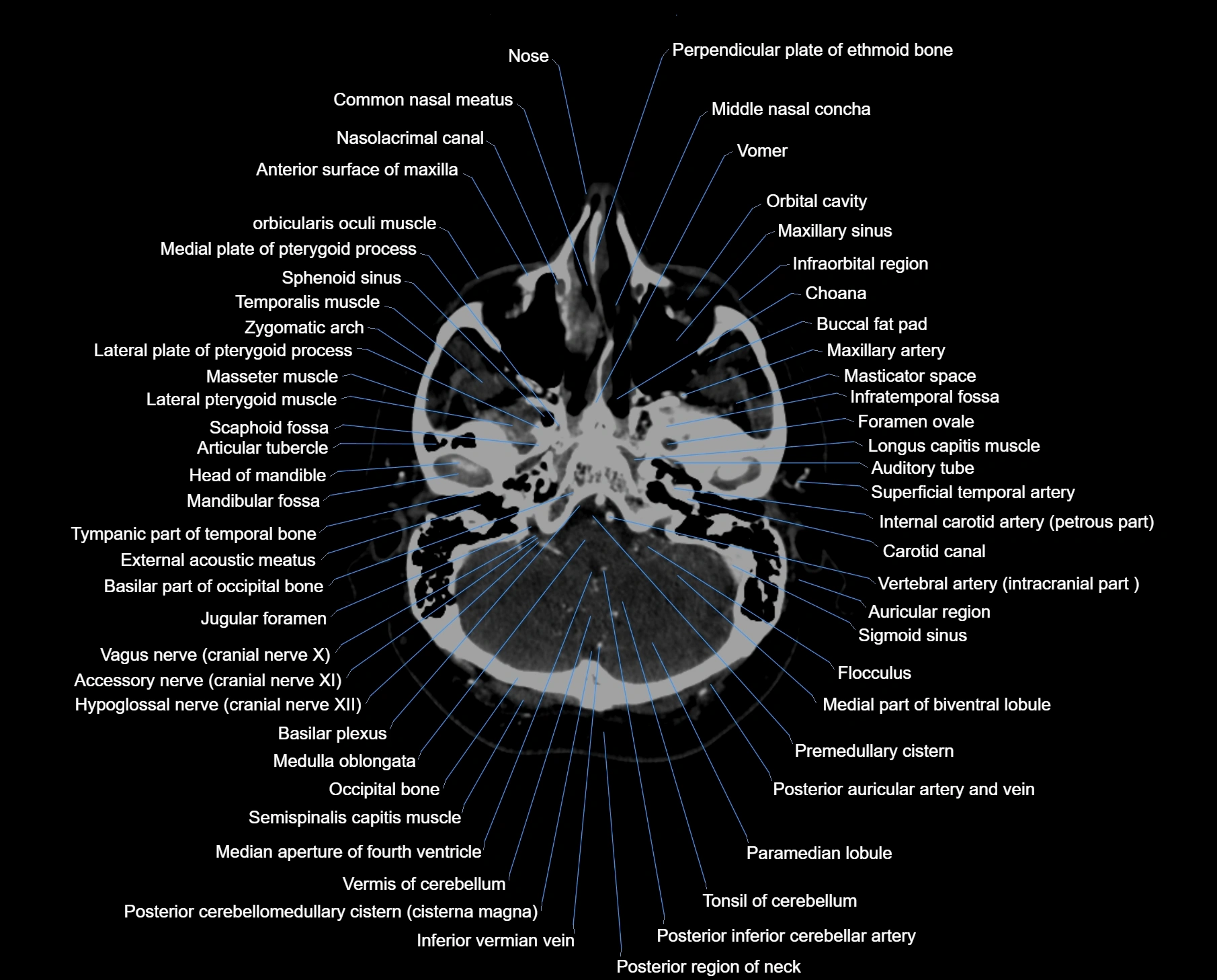 CT scan brain axial labelled cross sectional anatomy image-img-000011.webp